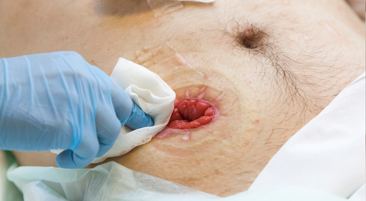 Life After Stoma Surgery: What to Expect